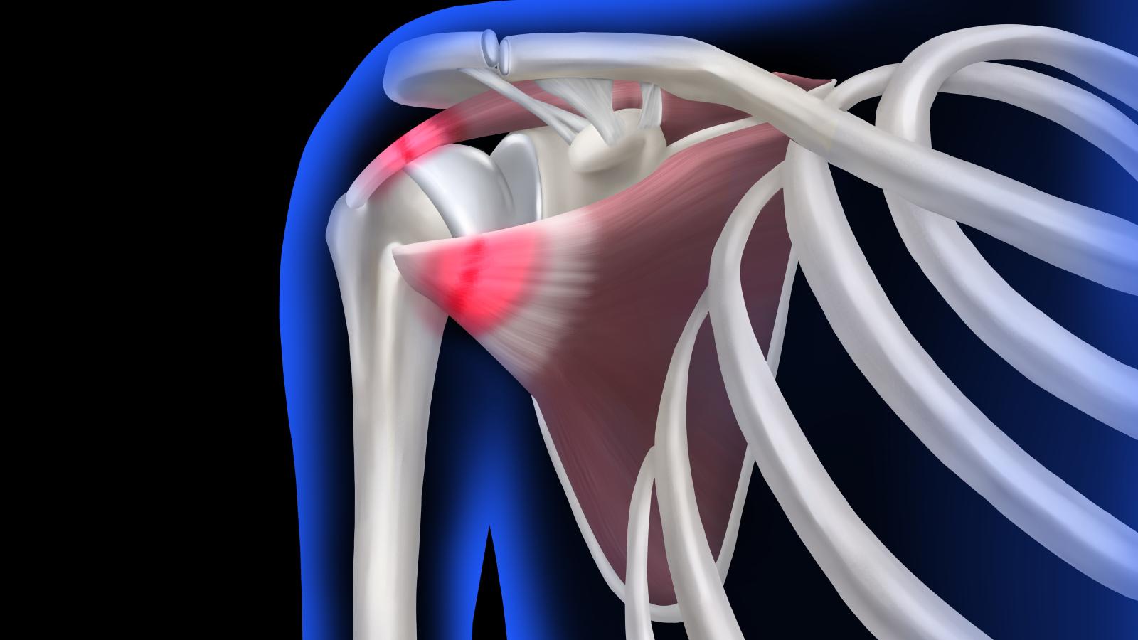 Rotator.Cuff.shoulder-pain