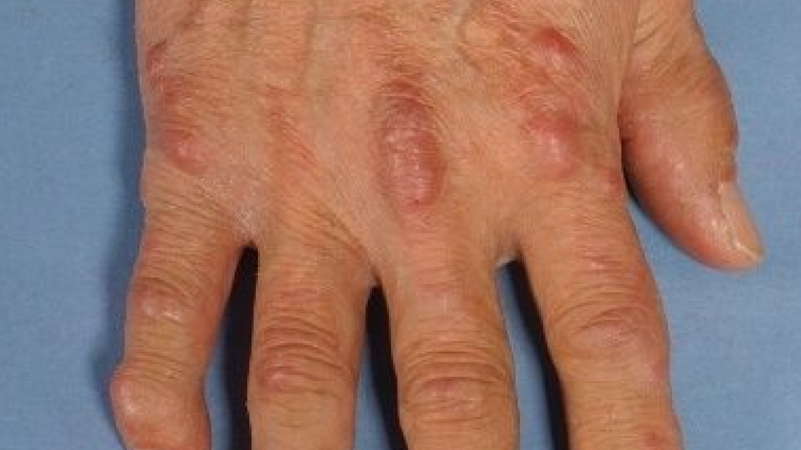 Multicentric reticulohistiocytosis
