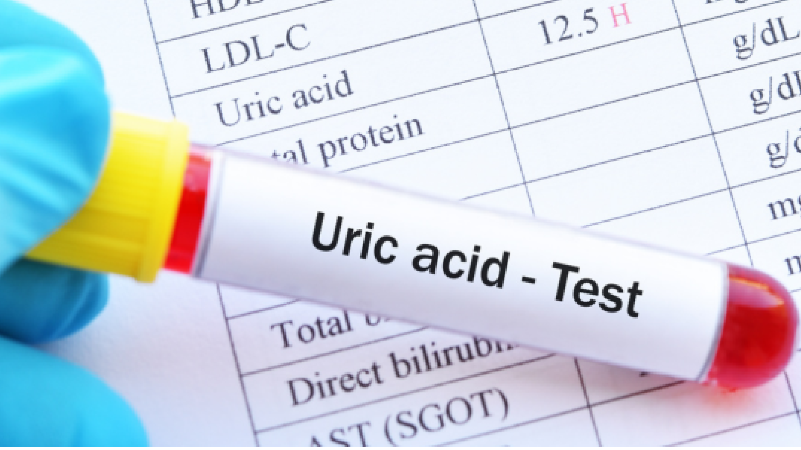 uric.acid.test