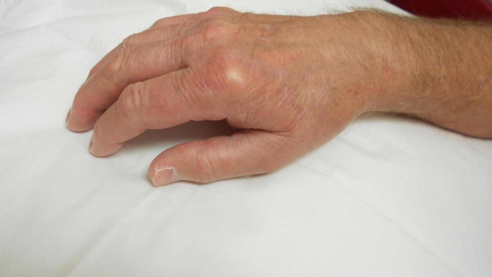 CPPD,hand,MCP