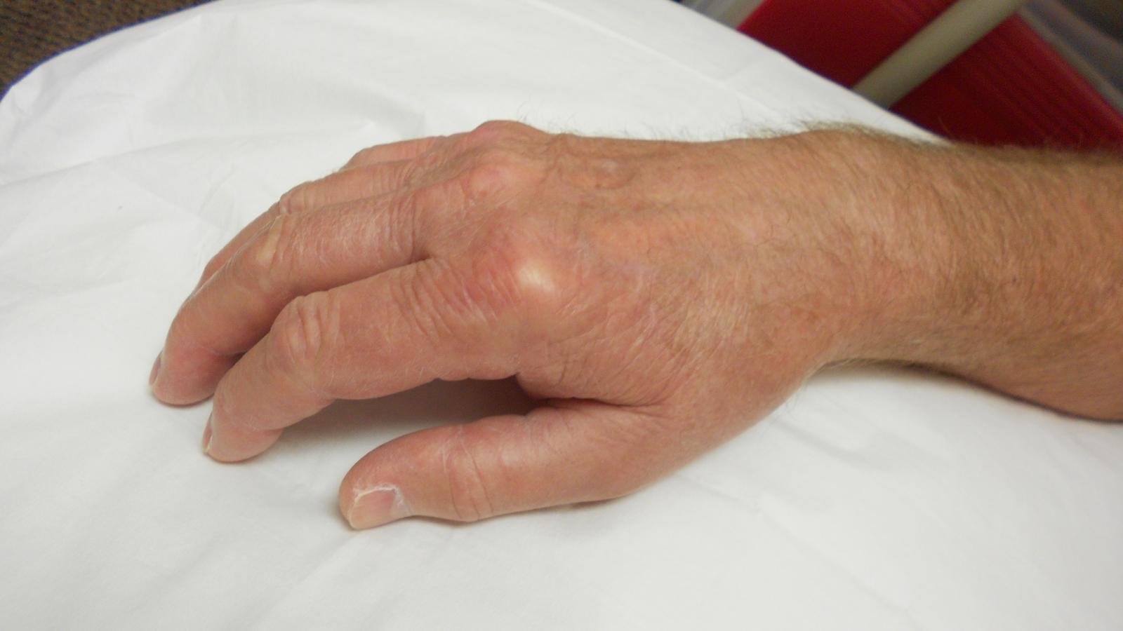 CPPD,hand,MCP