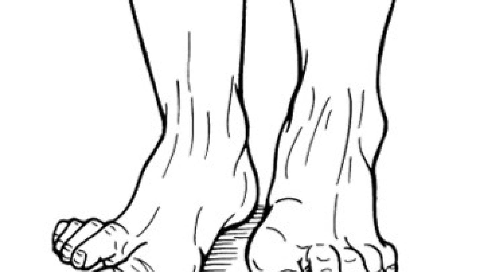 MTP.Hallux
