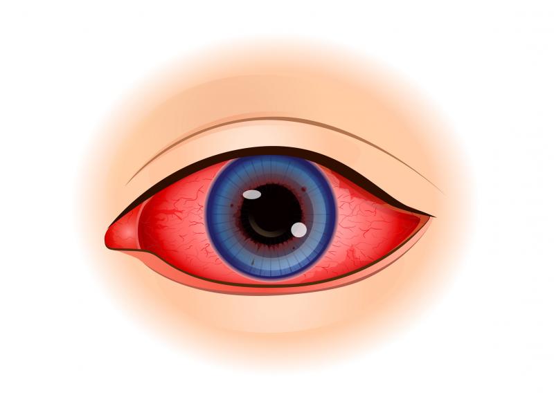 uveitis eye iritis