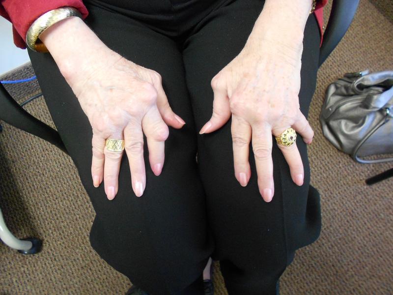 Rheumatoid,RA,nodules,damage