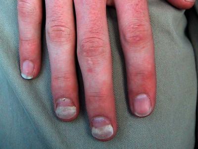 Figure 1 from Psoriatic Nail Changes Are Associated With Clinical Outcomes  in Psoriatic Arthritis | Semantic Scholar